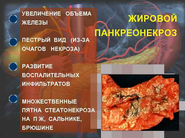 УВЕЛИЧЕНИЕ ОБЪЕМА ЖИРОВОЙ ЖЕЛЕЗЫ ПЕСТРЫЙ ВИД (ИЗ-ЗА ПАНКРЕОНЕКРОЗ ЖИРОВОЙ ОЧАГОВ НЕКРОЗА) РАЗВИТИЕ ВОСПАЛИТЕЛЬНЫХ ИНФИЛЬТРАТОВ