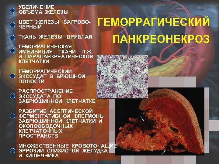 УВЕЛИЧЕНИЕ ОБЪЕМА ЖЕЛЕЗЫ ЦВЕТ ЖЕЛЕЗЫ БАГРОВОЧЕРНЫЙ ГЕМОРРАГИЧЕСКИЙ ТКАНЬ ЖЕЛЕЗЫ ДРЯБЛАЯ ГЕМОРРАГИЧЕСКАЯ ИМБИБИЦИЯ ТКАНИ П