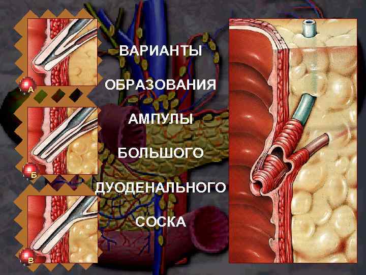 ВАРИАНТЫ А ОБРАЗОВАНИЯ АМПУЛЫ БОЛЬШОГО Б ДУОДЕНАЛЬНОГО СОСКА В 