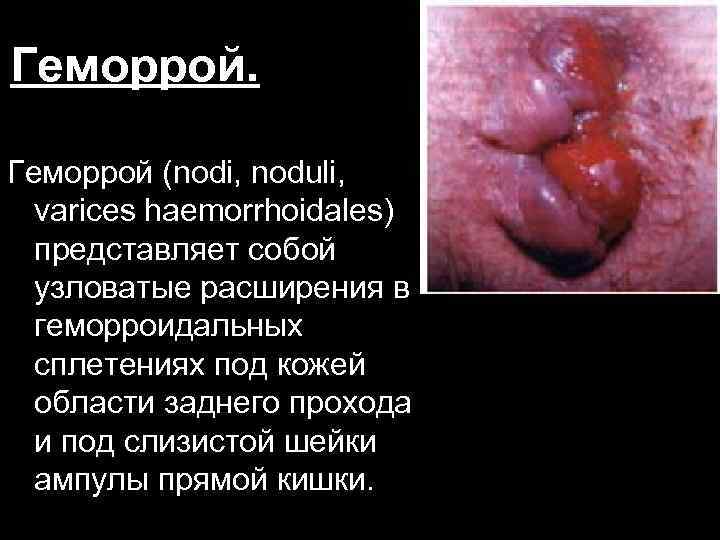 Геморрой (nodi, noduli, varices haemorrhoidales) представляет собой узловатые расширения в геморроидальных сплетениях под кожей