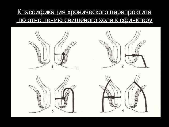 Транссфинктерный свищ прямой. Хронический парапроктит классификация. Острый парапроктит классификация. Врожденные параректальные свищи классификация.