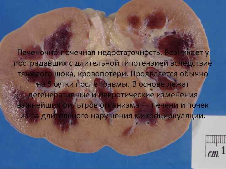 Печеночно-почечная недостаточность. Возникает у пострадавших с длительной гипотензией вследствие тяжелого шока, кровопотери. Проявляется обычно