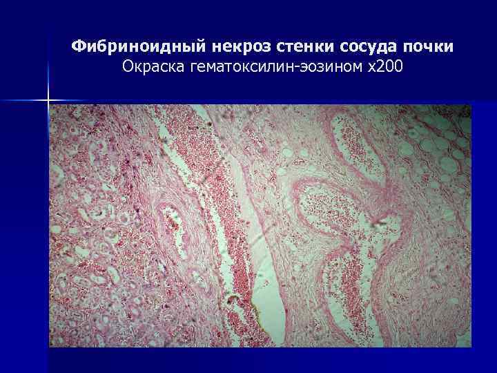Фибриноидный некроз стенки сосуда почки Окраска гематоксилин-эозином х200 