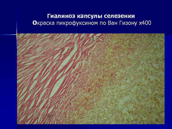 Гиалиноз капсулы селезенки Окраска пикрофуксином по Ван Гизону х400 