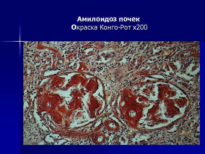 Амилоидоз почек Окраска Конго-Рот х200 