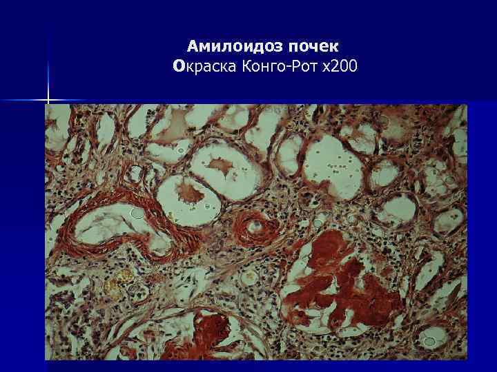 Амилоидоз почек Окраска Конго-Рот х200 