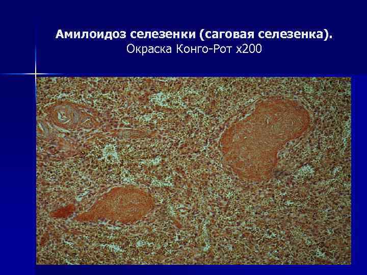 Амилоидоз селезенки (саговая селезенка). Окраска Конго-Рот х200 