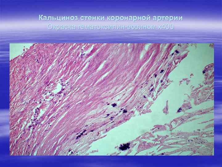 Кальциноз стенки коронарной артерии Окраска гематоксилин-эозином х400 