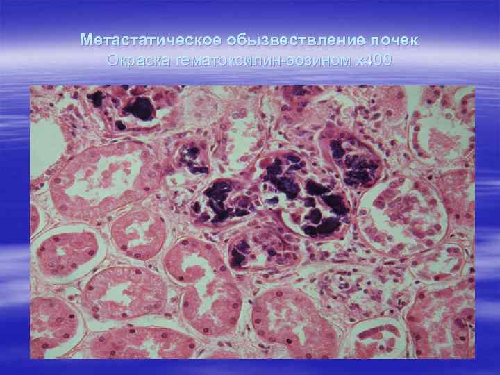 Метастатическое обызвествление почек Окраска гематоксилин-эозином х400 