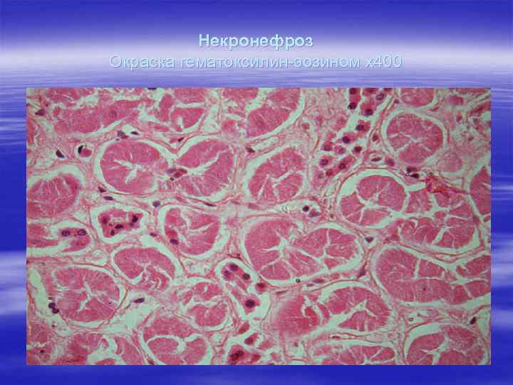 Некронефроз Окраска гематоксилин-эозином х400 