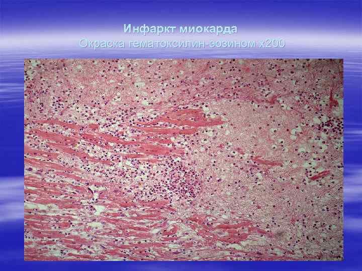 Инфаркт миокарда Окраска гематоксилин-эозином х200 