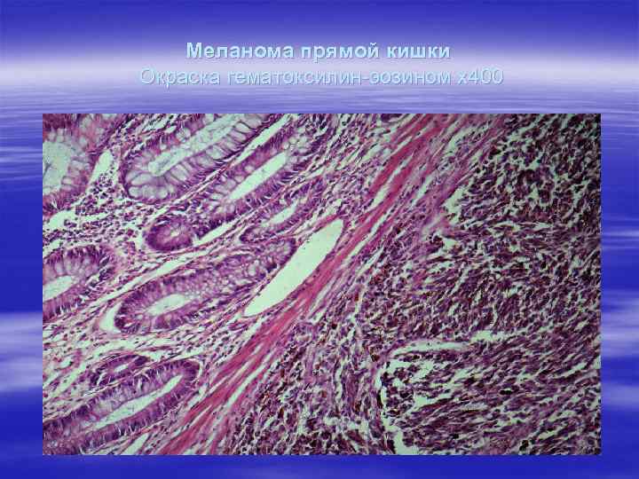 Меланома прямой кишки Окраска гематоксилин-эозином х400 