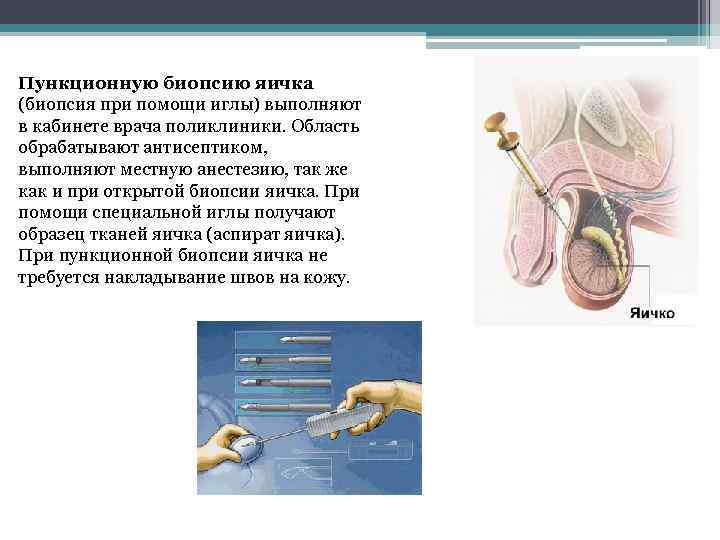 Пункционную биопсию яичка (биопсия при помощи иглы) выполняют в кабинете врача поликлиники. Область обрабатывают