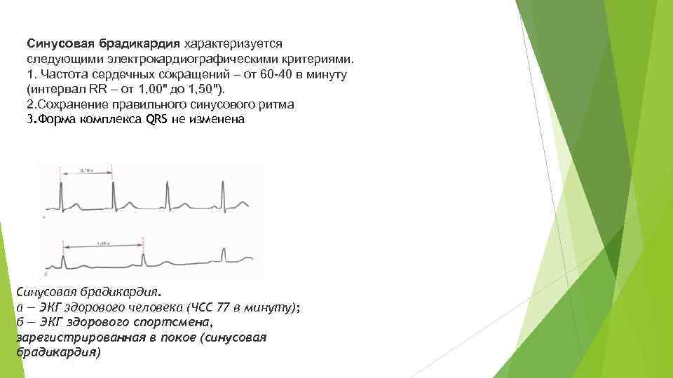 Синусовая брадикардия характеризуется следующими электрокардиографическими критериями. 1. Частота сердечных сокращений – от 60 -40