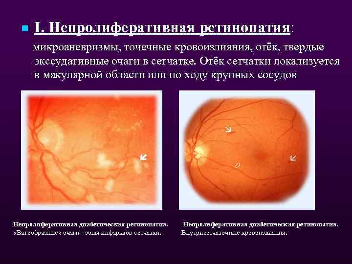 n I. Непролиферативная ретинопатия: микроаневризмы, точечные кровоизлияния, отёк, твердые экссудативные очаги в сетчатке. Отёк