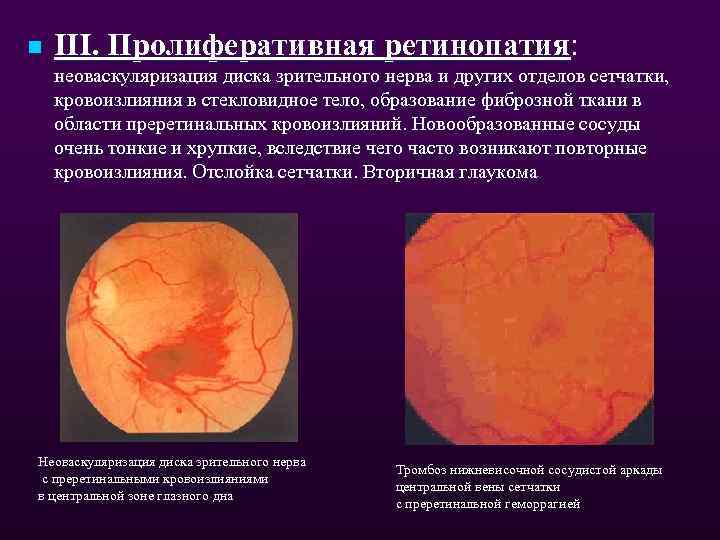 n III. Пролиферативная ретинопатия: неоваскуляризация диска зрительного нерва и других отделов сетчатки, кровоизлияния в