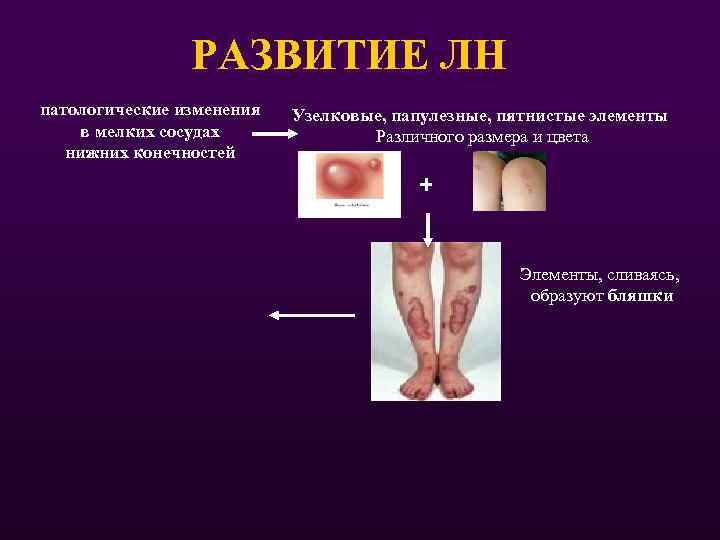 РАЗВИТИЕ ЛН патологические изменения в мелких сосудах нижних конечностей Узелковые, папулезные, пятнистые элементы Различного