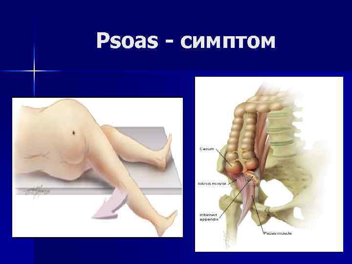 Psoas - симптом 