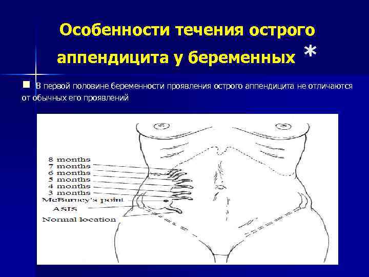 Особенности течения острого аппендицита у беременных n * В первой половине беременности проявления острого