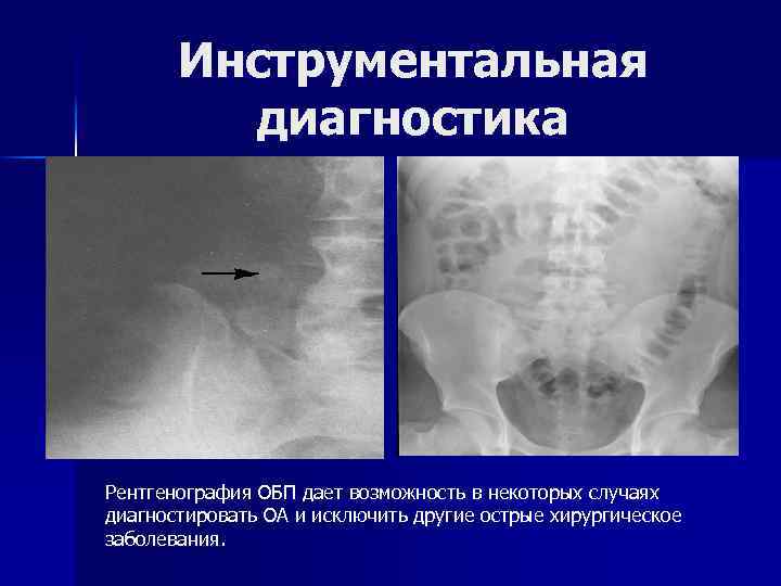 Инструментальная диагностика Рентгенография ОБП дает возможность в некоторых случаях диагностировать ОА и исключить другие