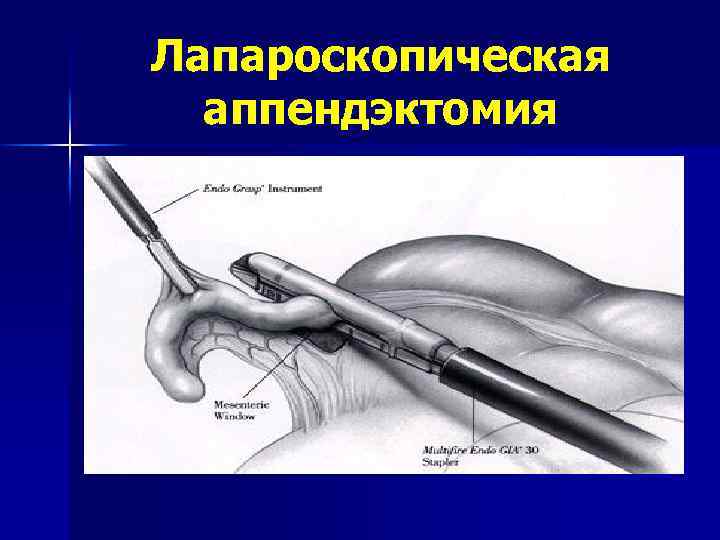 Лапароскопическая аппендэктомия 