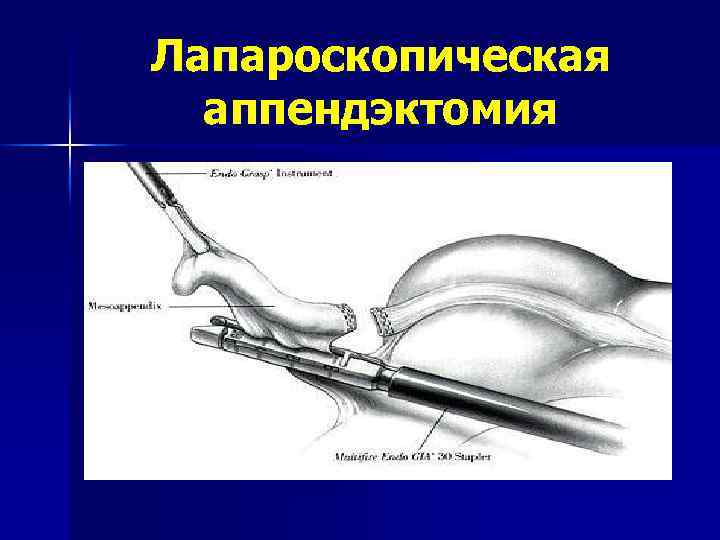 Лапароскопическая аппендэктомия 