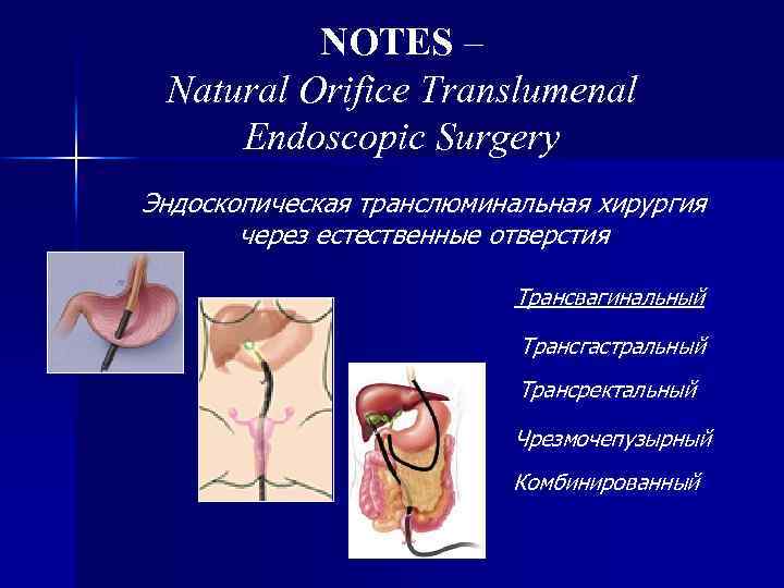 NOTES – Natural Orifice Translumenal Endoscopic Surgery Эндоскопическая транслюминальная хирургия через естественные отверстия Трансвагинальный