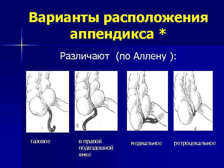 Варианты расположения аппендикса * Различают (по Аллену ): тазовое в правой подвздошной ямке медиальное