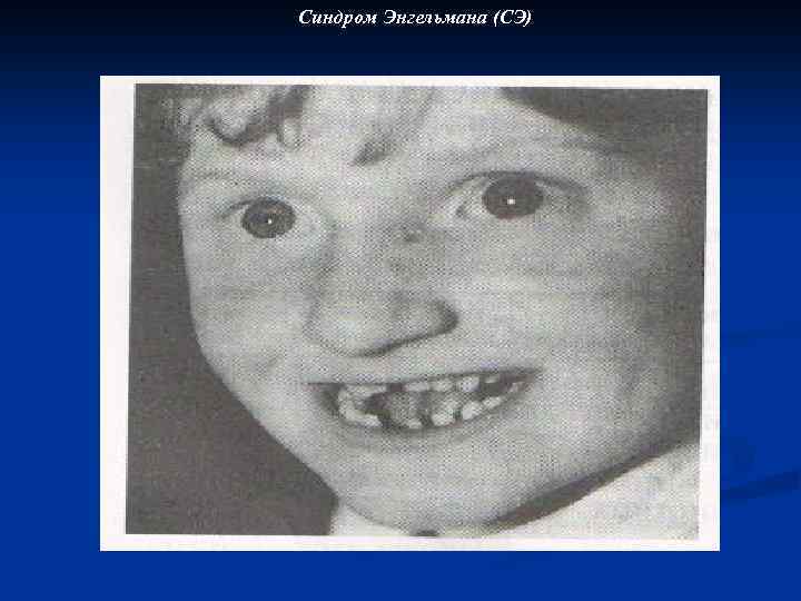 Синдром Энгельмана (СЭ) 
