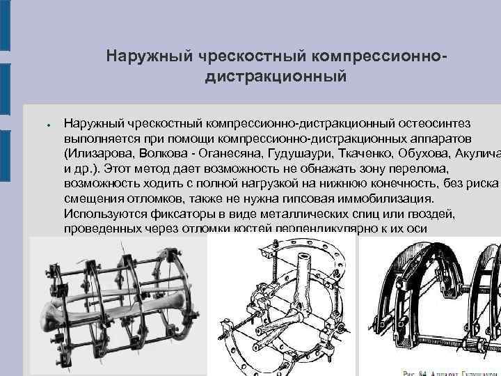 Внеочаговый остеосинтез презентация