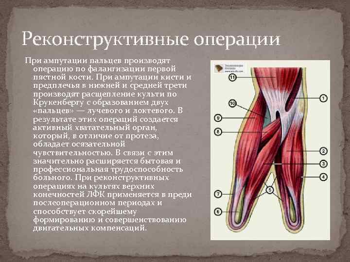 Реконструктивные операции При ампутации пальцев производят операцию по фалангизации первой пястной кости. При ампутации