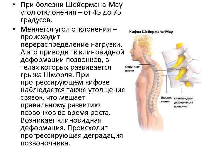  • При болезни Шейермана-Мау угол отклонения – от 45 до 75 градусов. •