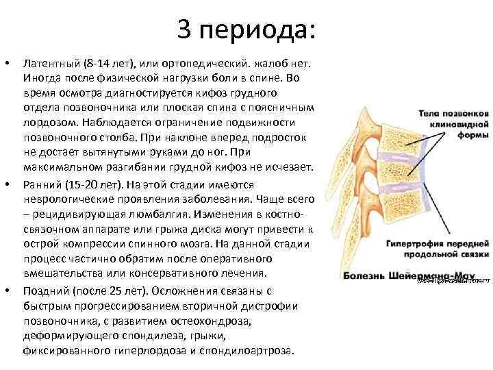 Болезнь шейермана мау