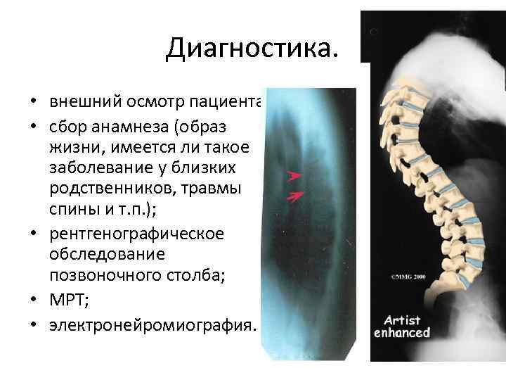 Диагностика. • внешний осмотр пациента; • сбор анамнеза (образ жизни, имеется ли такое заболевание