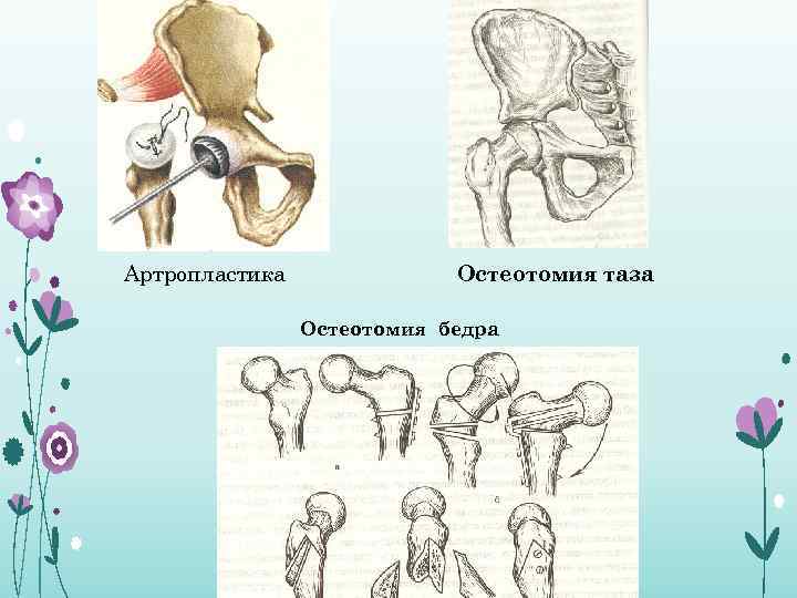 Артропластика Остеотомия таза Остеотомия бедра 