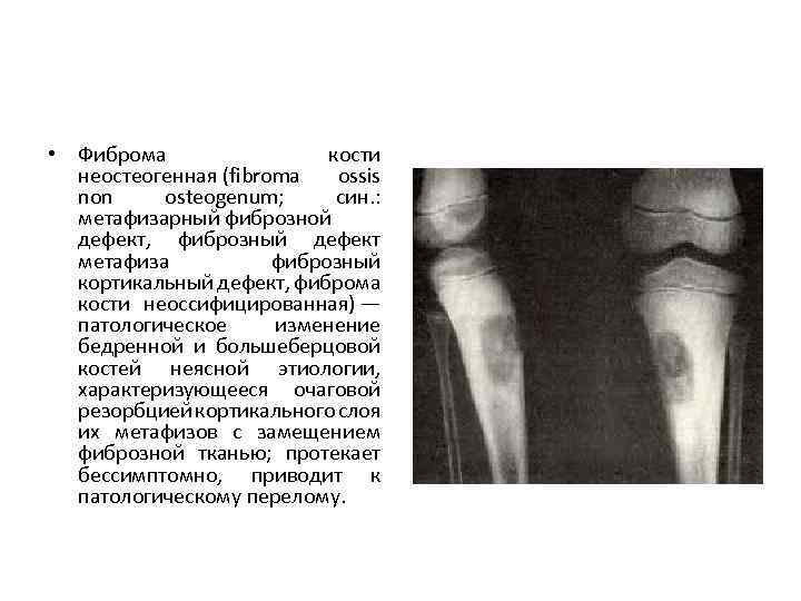  • Фиброма кости неостеогенная (fibroma ossis non osteogenum; син. : метафизарный фиброзной дефект,
