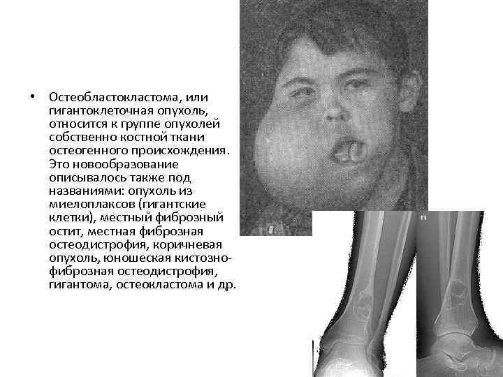  • Остеобластокластома, или гигантоклеточная опухоль, относится к группе опухолей собственно костной ткани остеогенного