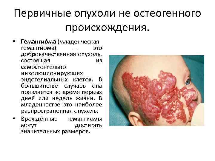Первичные опухоли не остеогенного происхождения. • Гемангио ма (младенческая гемангиома) — это доброкачественная опухоль,