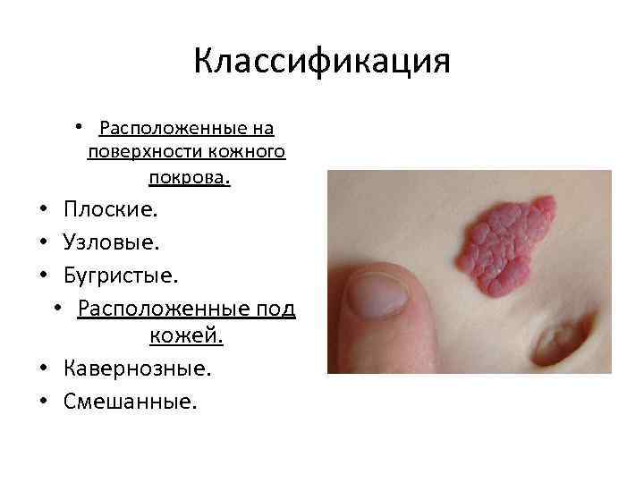 Классификация • Расположенные на поверхности кожного покрова. • Плоские. • Узловые. • Бугристые. •