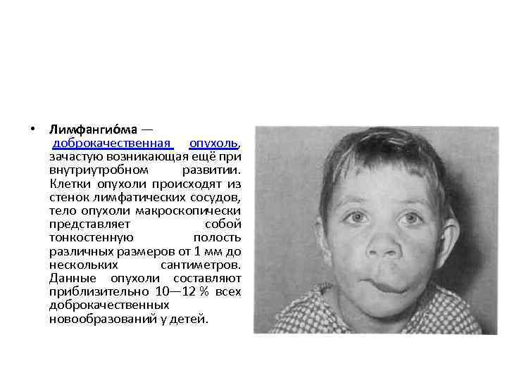  • Лимфангио ма — доброкачественная опухоль, зачастую возникающая ещё при внутриутробном развитии. Клетки