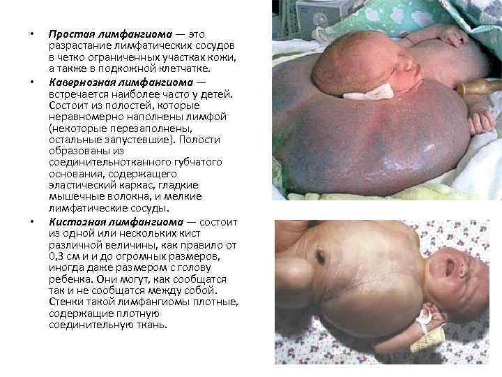  • • • Простая лимфангиома — это разрастание лимфатических сосудов в четко ограниченных