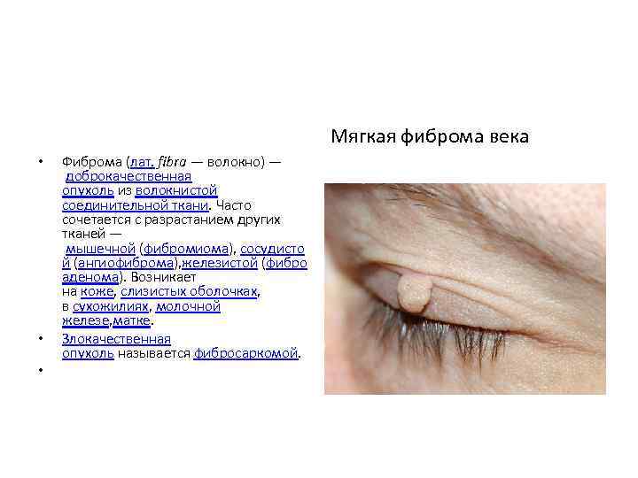 Мягкая фиброма века • • • Фиброма (лат. fibra — волокно) — доброкачественная опухоль