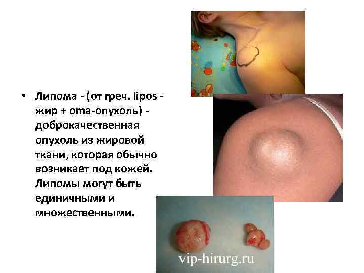  • Липома - (от греч. lipos - жир + oma-опухоль) - доброкачественная опухоль