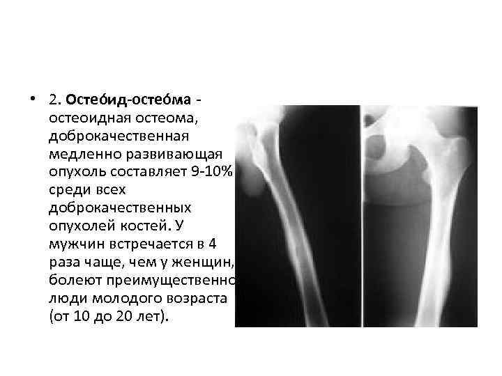 Остеома бедренной кости рентген картина