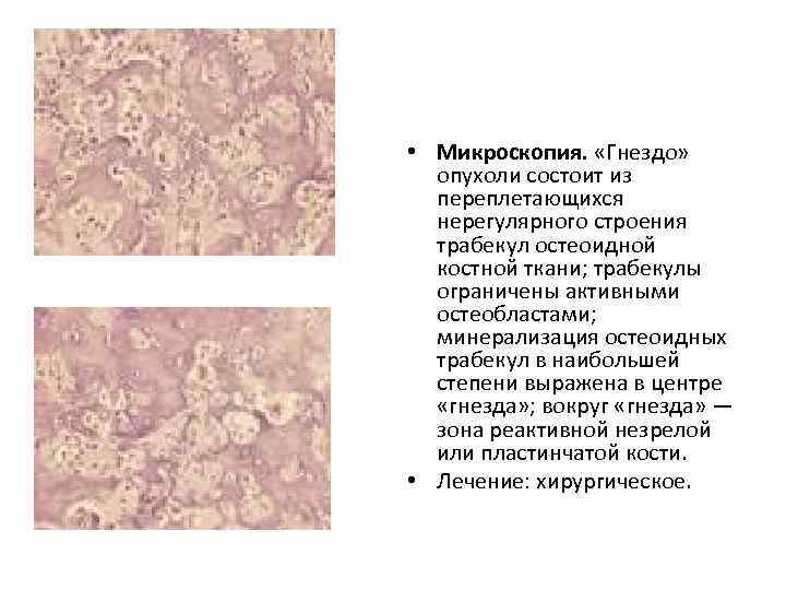  • Микроскопия. «Гнездо» опухоли состоит из переплетающихся нерегулярного строения трабекул остеоидной костной ткани;