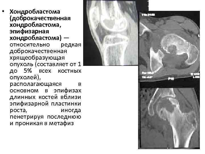  • Хондробластома (доброкачественная хондробластома, эпифизарная хондробластома) — относительно редкая доброкачественная хрящеобразующая опухоль (составляет