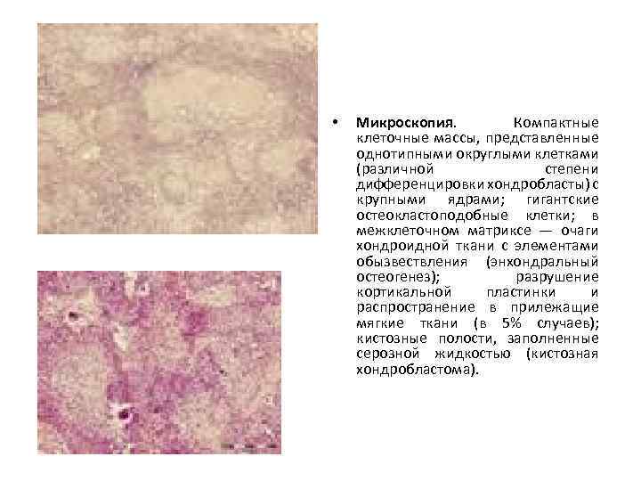  • Микроскопия. Компактные клеточные массы, представленные однотипными округлыми клетками (различной степени дифференцировки хондробласты)