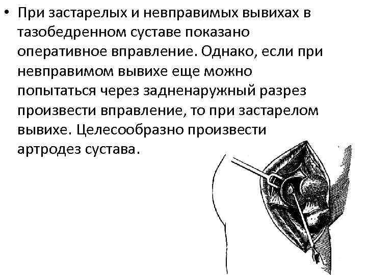  • При застарелых и невправимых вывихах в тазобедренном суставе показано оперативное вправление. Однако,