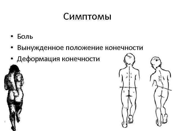 Симптомы • Боль • Вынужденное положение конечности • Деформация конечности 