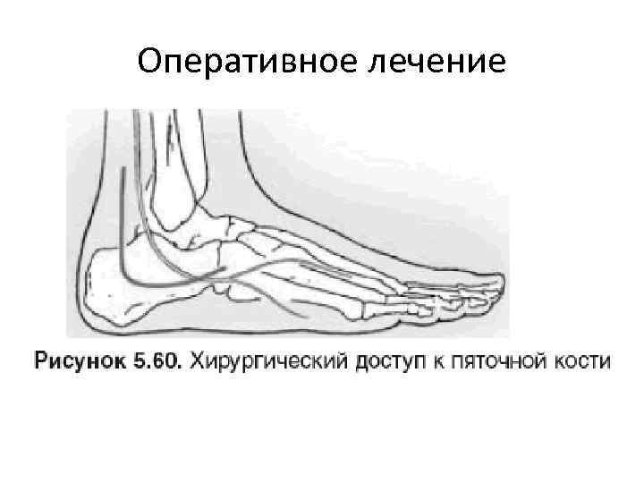 Перелом пяточной кости карта вызова